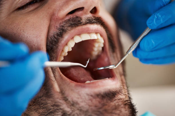 Best Emergency Wisdom Teeth Removal in Wingate, NC